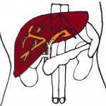 【初心者向け】腹部エコー（超音波）画像と疾患の見方～肝臓編～
